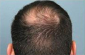 FUE hair transplant before